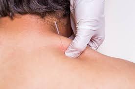 Dry Needling shoulder